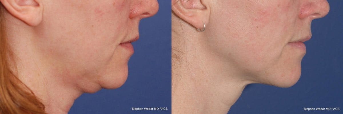 Kybella Before & After Gallery - Patient 360672 - Image 3