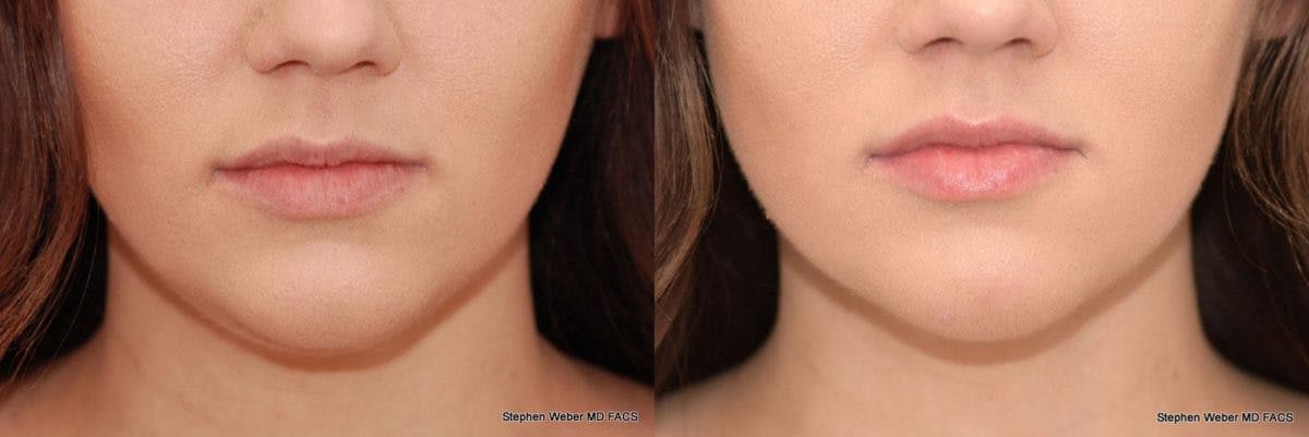 Kybella Before & After Gallery - Patient 213002 - Image 1
