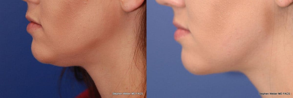 Kybella Before & After Gallery - Patient 213002 - Image 2