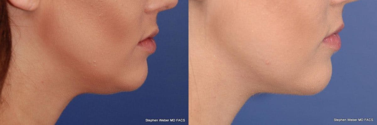 Kybella Before & After Gallery - Patient 213002 - Image 3
