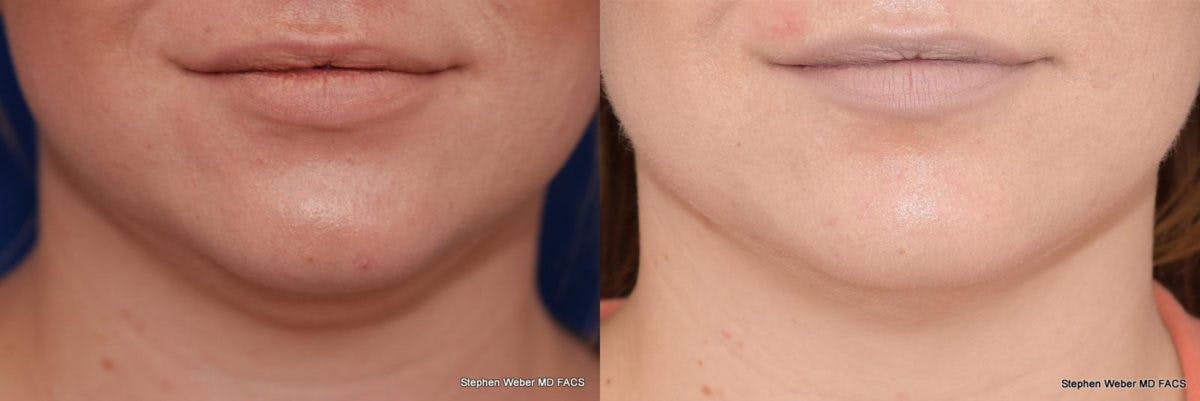 Kybella Before & After Gallery - Patient 232961 - Image 1