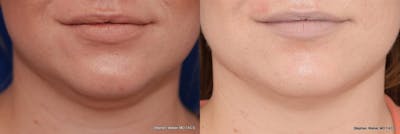 Kybella Before & After Gallery - Patient 232961 - Image 1