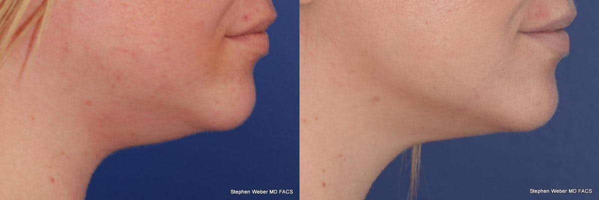 Kybella Before & After Gallery - Patient 232961 - Image 2