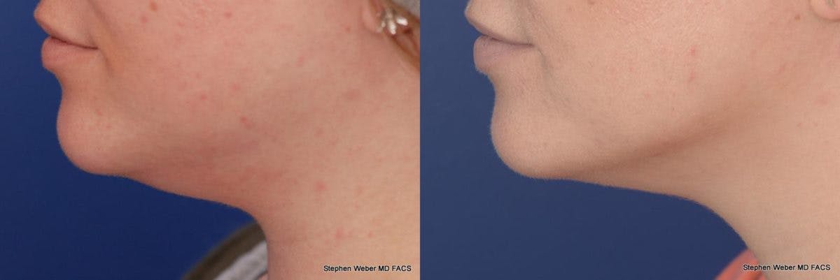 Kybella Before & After Gallery - Patient 232961 - Image 3