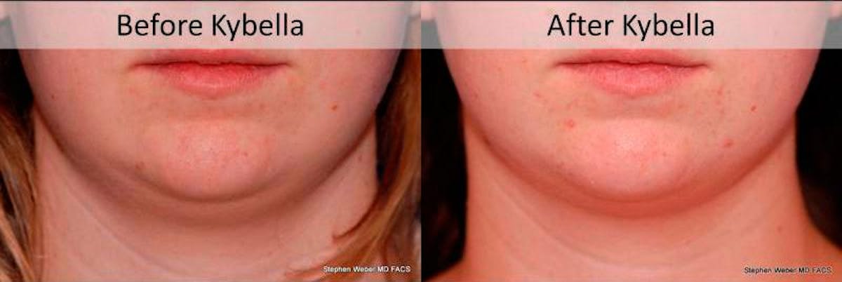 Kybella Before & After Gallery - Patient 315120 - Image 1