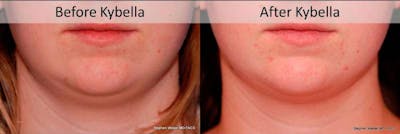 Kybella Before & After Gallery - Patient 315120 - Image 1