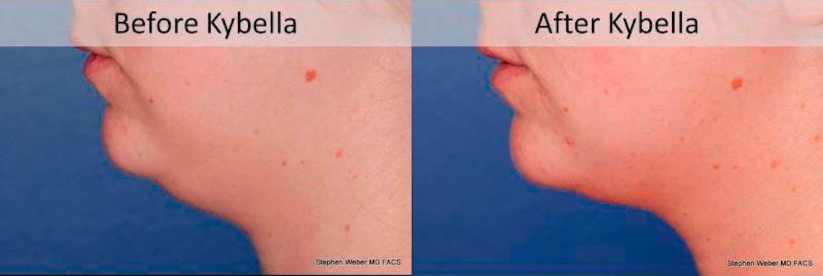 Kybella Before & After Gallery - Patient 315120 - Image 2