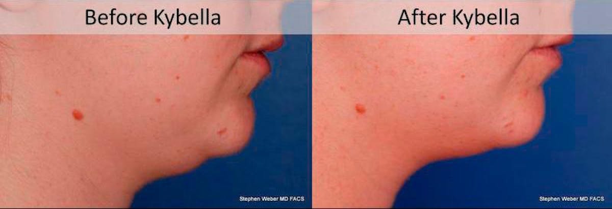 Kybella Before & After Gallery - Patient 315120 - Image 3