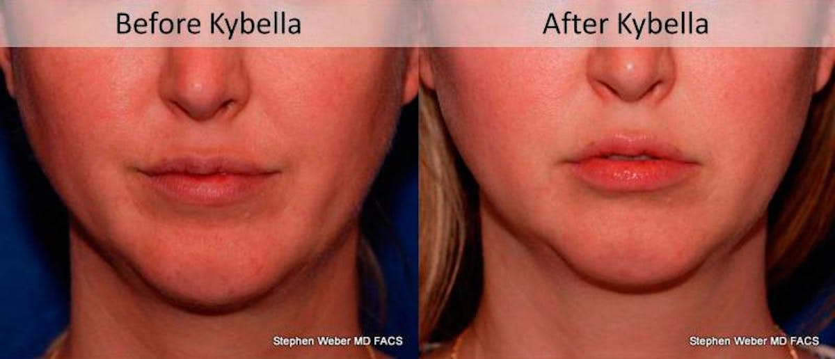 Kybella Before & After Gallery - Patient 221811 - Image 1