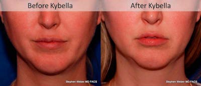 Kybella Before & After Gallery - Patient 221811 - Image 1