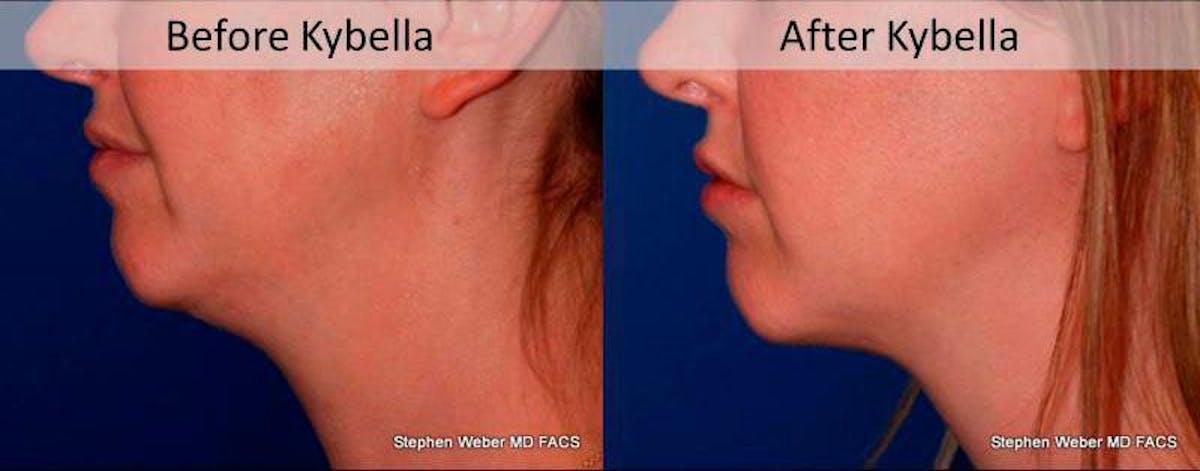 Kybella Before & After Gallery - Patient 221811 - Image 2