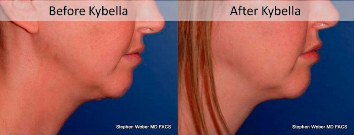 Kybella Before & After Gallery - Patient 221811 - Image 3