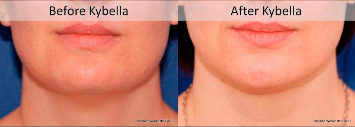 Kybella Before & After Gallery - Patient 323387 - Image 1
