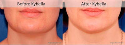 Kybella Before & After Gallery - Patient 323387 - Image 1