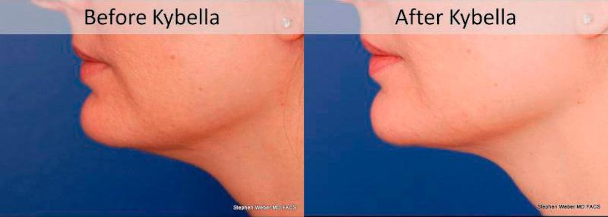 Kybella Before & After Gallery - Patient 323387 - Image 2