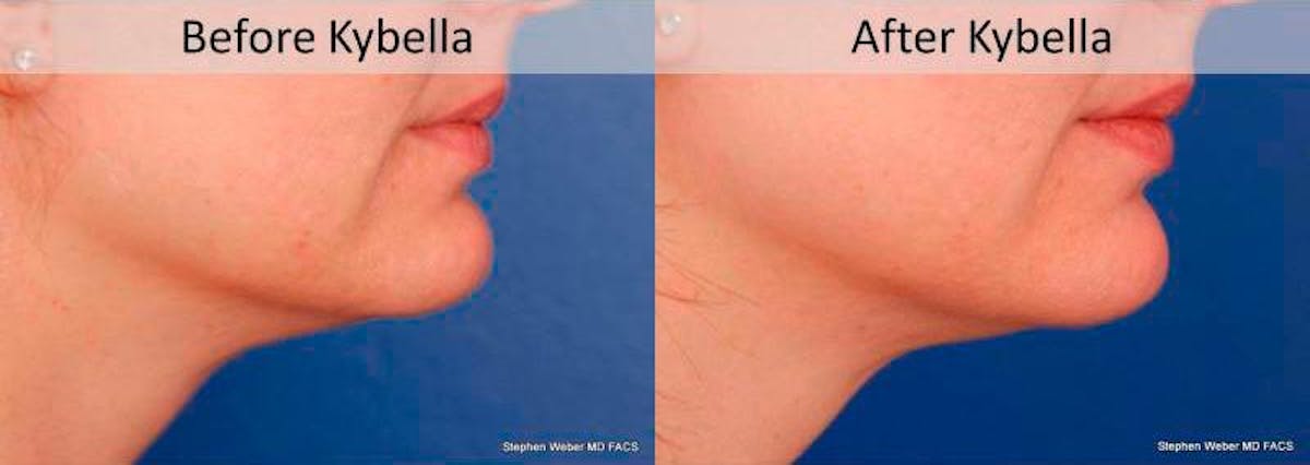 Kybella Before & After Gallery - Patient 323387 - Image 3
