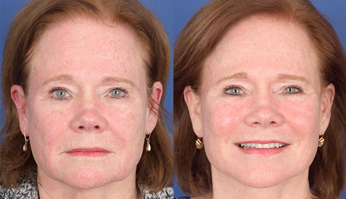 Laser Resurfacing Before & After Gallery - Patient 312624 - Image 1