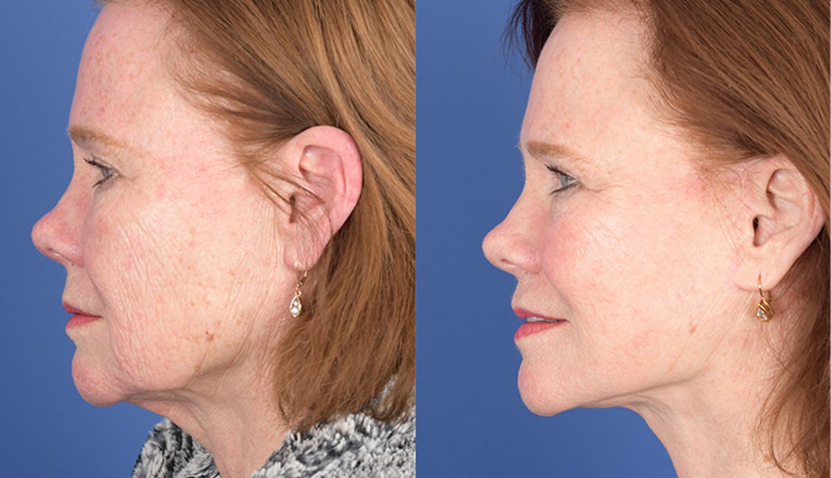 Laser Resurfacing Before & After Gallery - Patient 312624 - Image 2