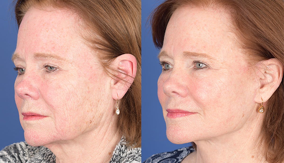 Laser Resurfacing Before & After Gallery - Patient 312624 - Image 3