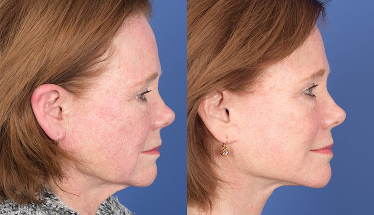 Laser Resurfacing Before & After Gallery - Patient 312624 - Image 4