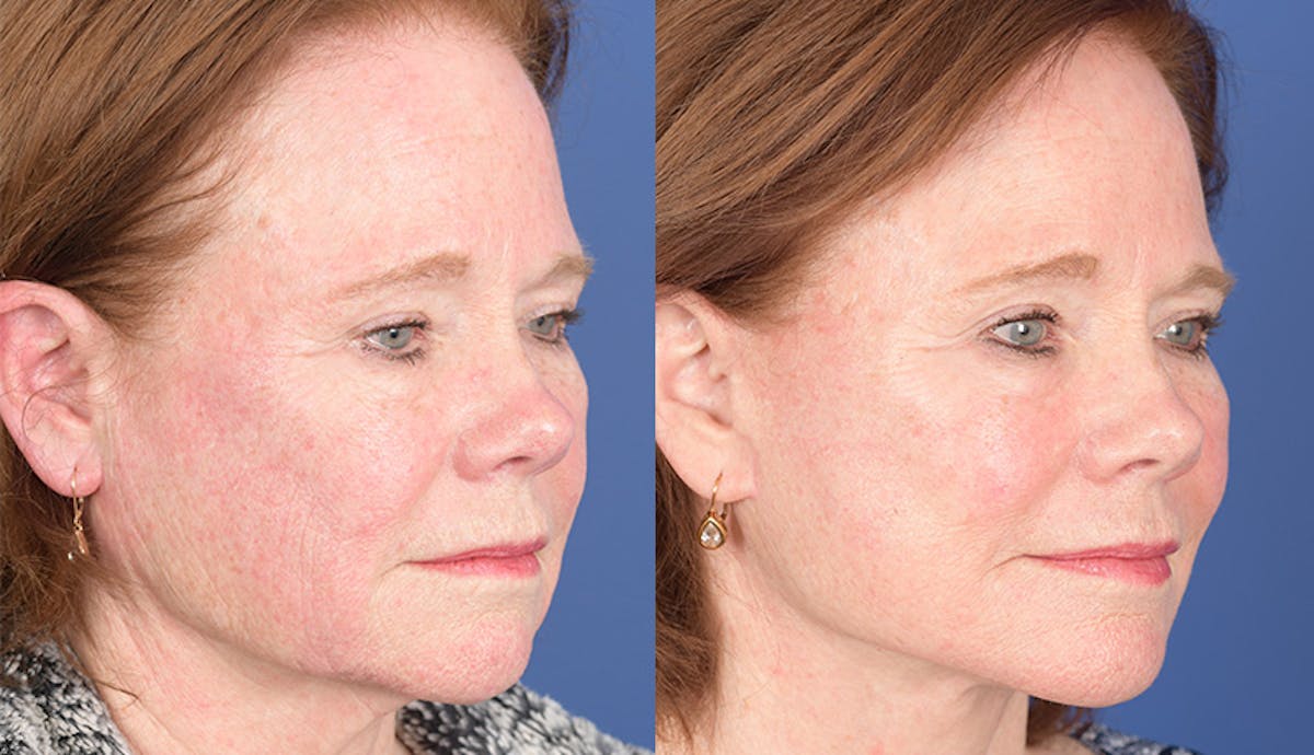 Laser Resurfacing Before & After Gallery - Patient 312624 - Image 5