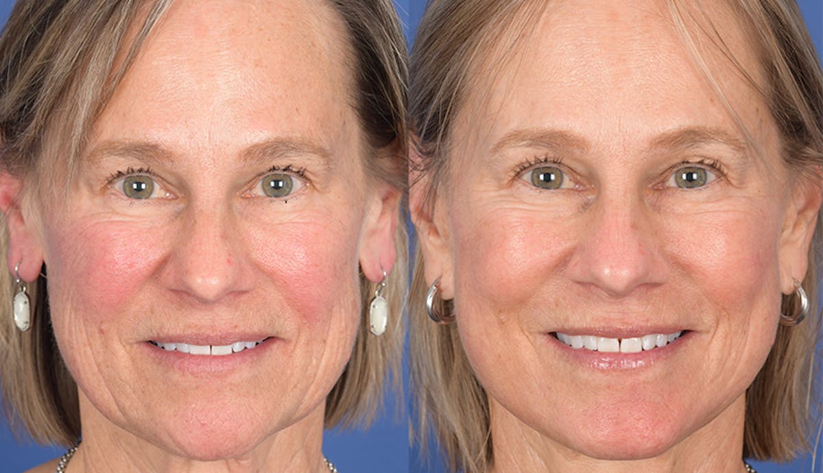 Laser Resurfacing Before & After Gallery - Patient 238251 - Image 1