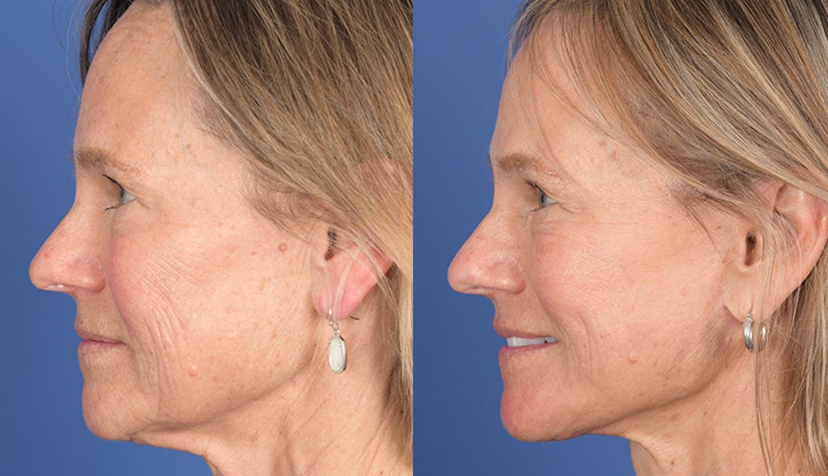 Laser Resurfacing Before & After Gallery - Patient 238251 - Image 2