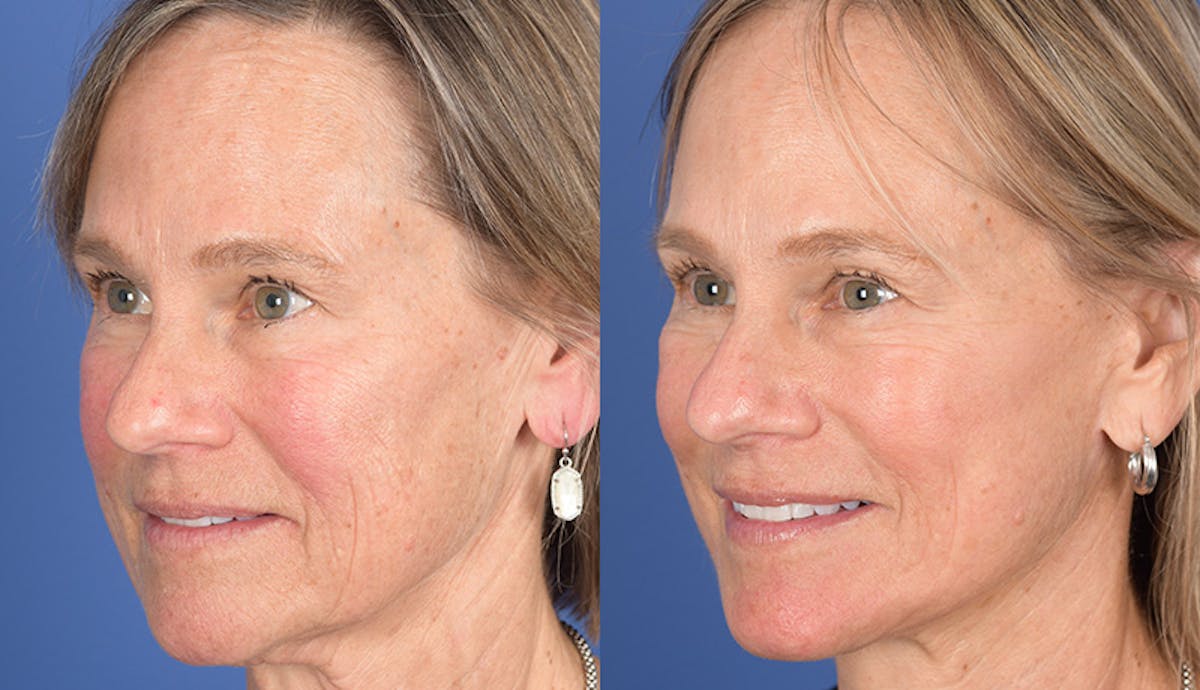 Laser Resurfacing Before & After Gallery - Patient 238251 - Image 3