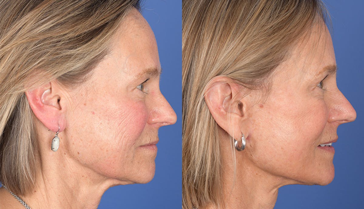 Laser Resurfacing Before & After Gallery - Patient 238251 - Image 4
