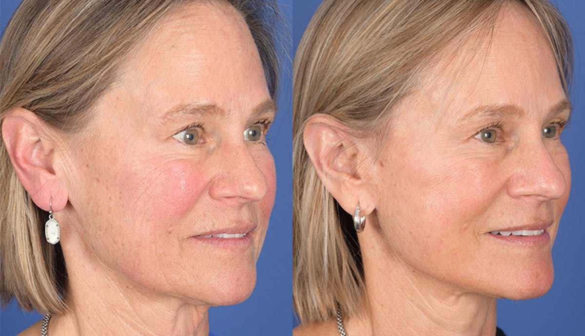 Laser Resurfacing Before & After Gallery - Patient 238251 - Image 5