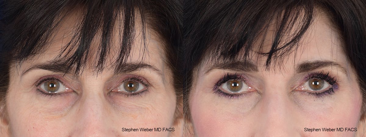 Laser Resurfacing Before & After Gallery - Patient 288223 - Image 1
