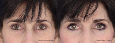 Laser Resurfacing Before & After Gallery - Patient 288223 - Image 1