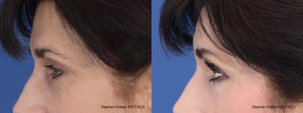 Laser Resurfacing Before & After Gallery - Patient 288223 - Image 2