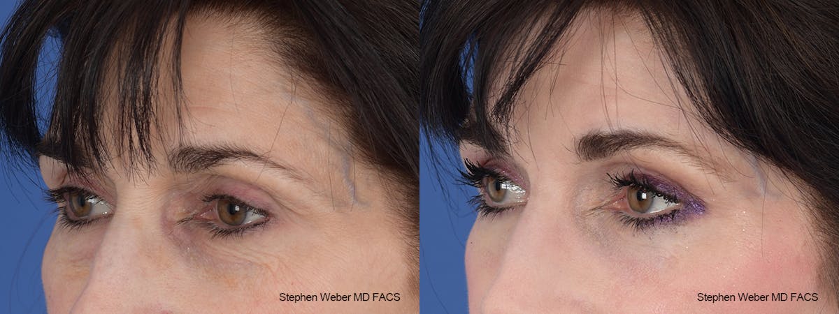 Laser Resurfacing Before & After Gallery - Patient 288223 - Image 3