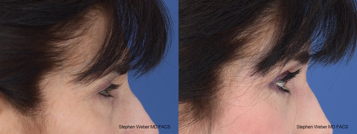 Laser Resurfacing Before & After Gallery - Patient 288223 - Image 4