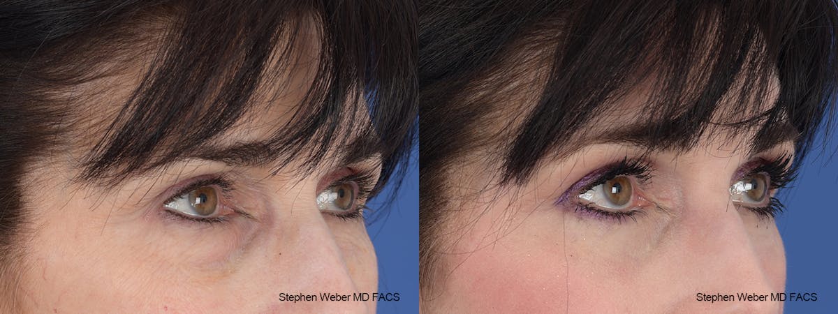 Laser Resurfacing Before & After Gallery - Patient 288223 - Image 5