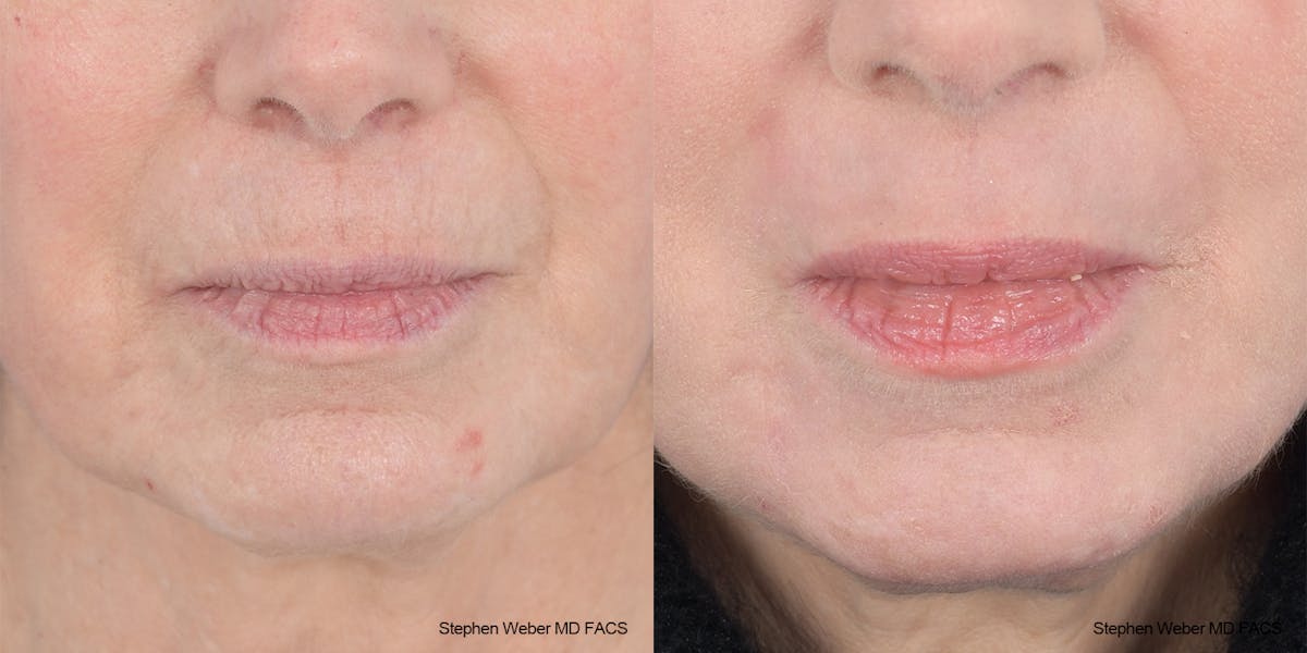 Laser Resurfacing Before & After Gallery - Patient 200639 - Image 1
