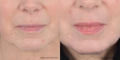 Laser Resurfacing Before & After Gallery - Patient 200639 - Image 1