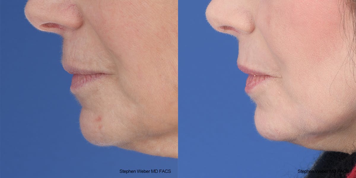 Laser Resurfacing Before & After Gallery - Patient 200639 - Image 2