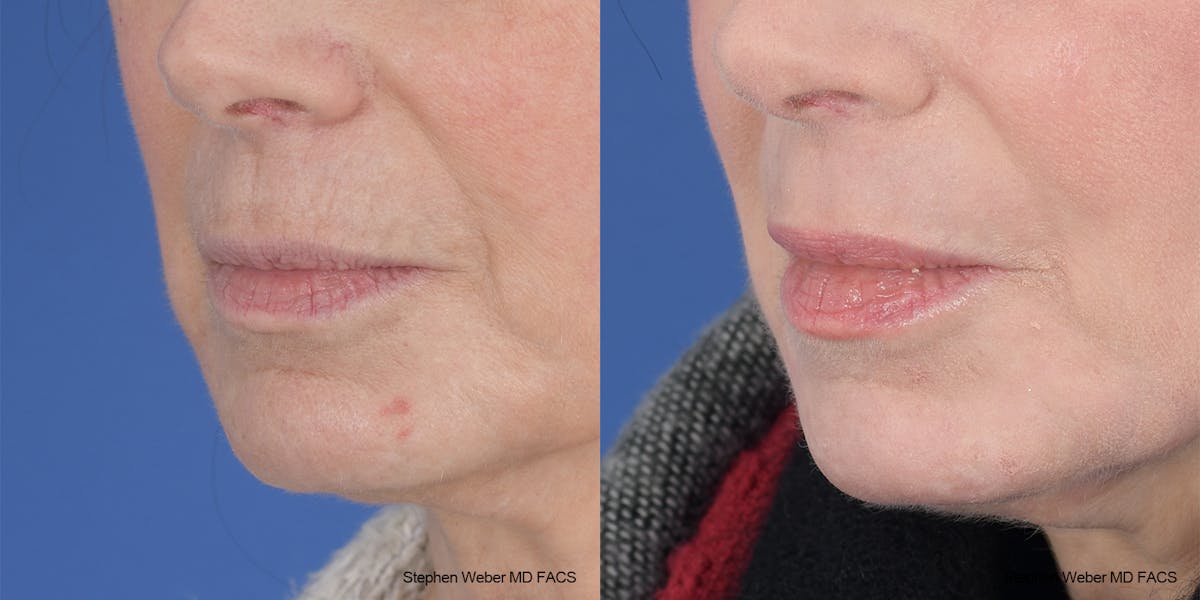 Laser Resurfacing Before & After Gallery - Patient 200639 - Image 3