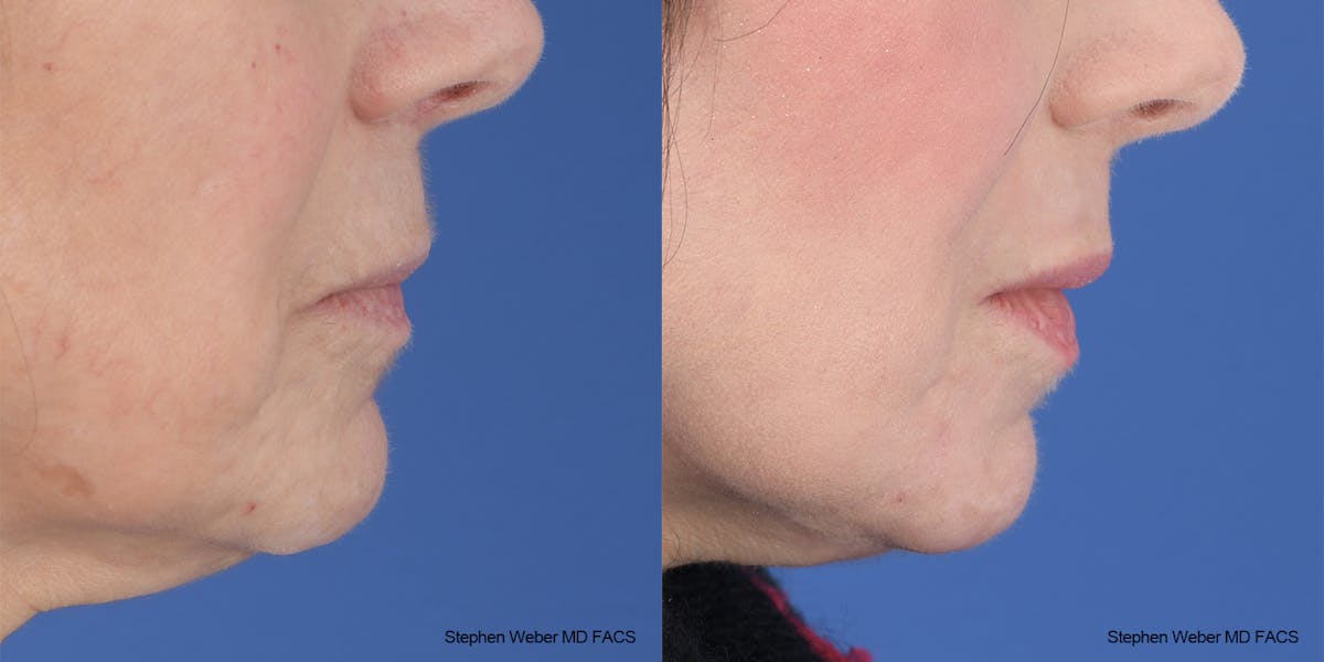 Laser Resurfacing Before & After Gallery - Patient 200639 - Image 4