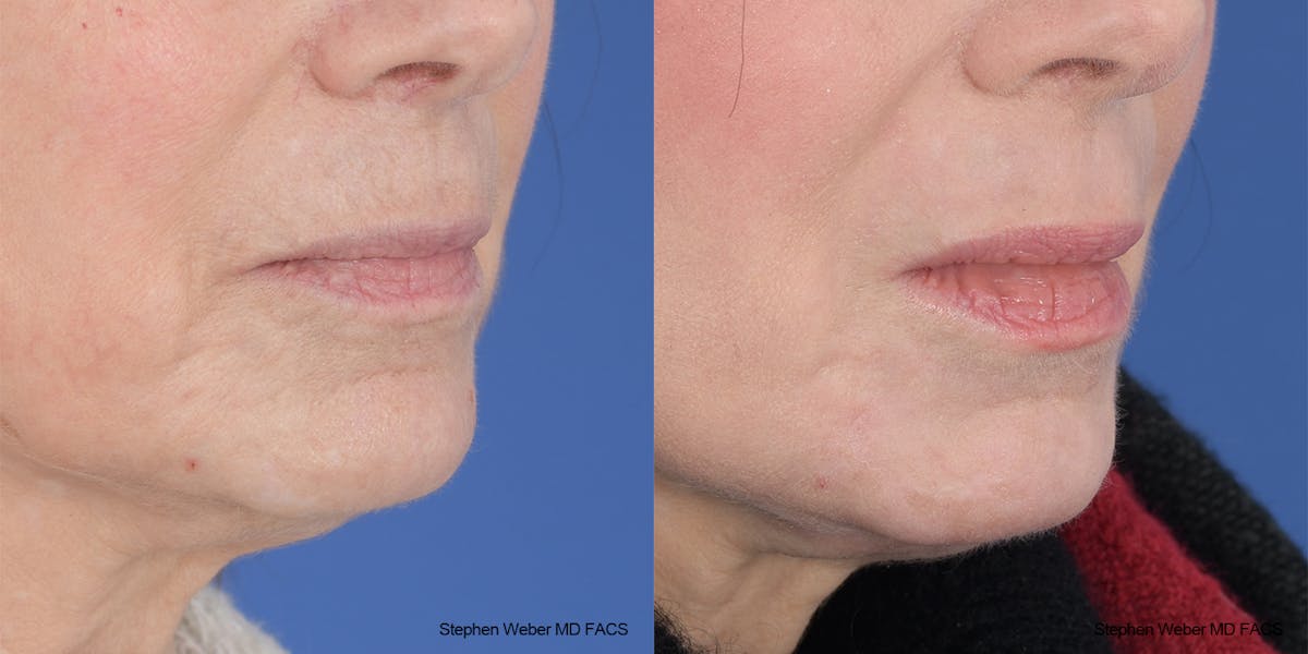 Laser Resurfacing Before & After Gallery - Patient 200639 - Image 5