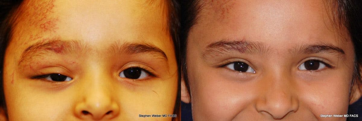 Laser Resurfacing Before & After Gallery - Patient 317974 - Image 1