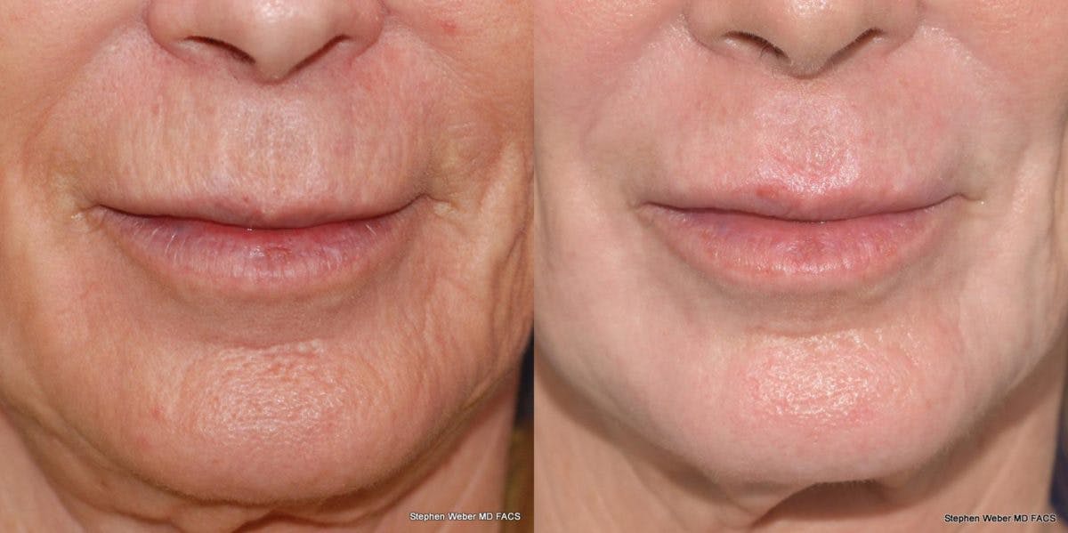 Laser Resurfacing Before & After Gallery - Patient 367440 - Image 1