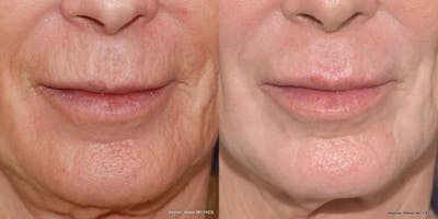Laser Resurfacing Before & After Gallery - Patient 367440 - Image 1
