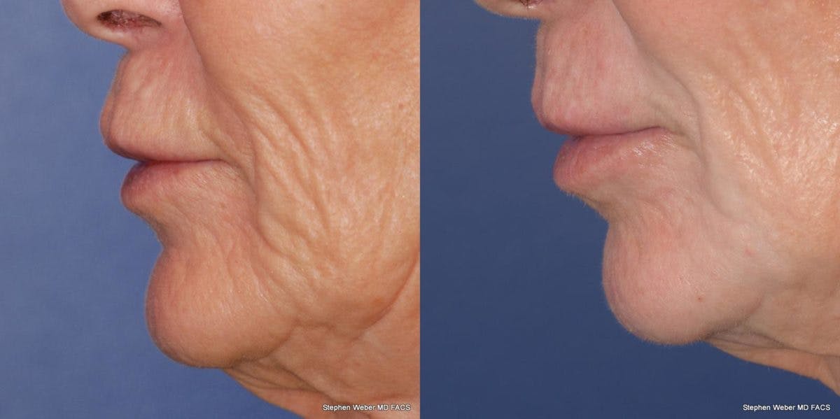 Laser Resurfacing Before & After Gallery - Patient 367440 - Image 2