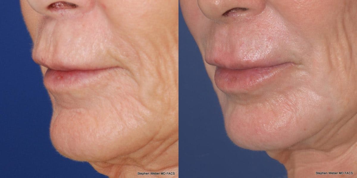 Laser Resurfacing Before & After Gallery - Patient 367440 - Image 3