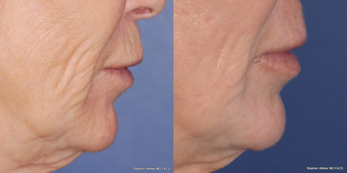 Laser Resurfacing Before & After Gallery - Patient 367440 - Image 4