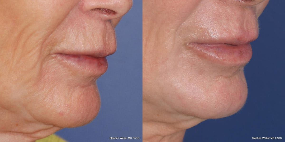Laser Resurfacing Before & After Gallery - Patient 367440 - Image 5