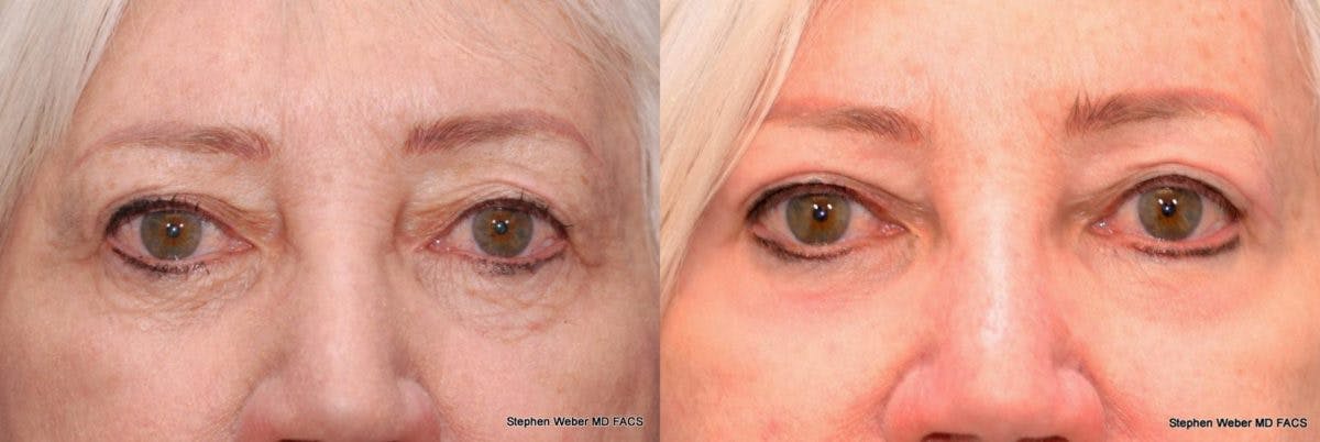 Laser Resurfacing Before & After Gallery - Patient 108566 - Image 1